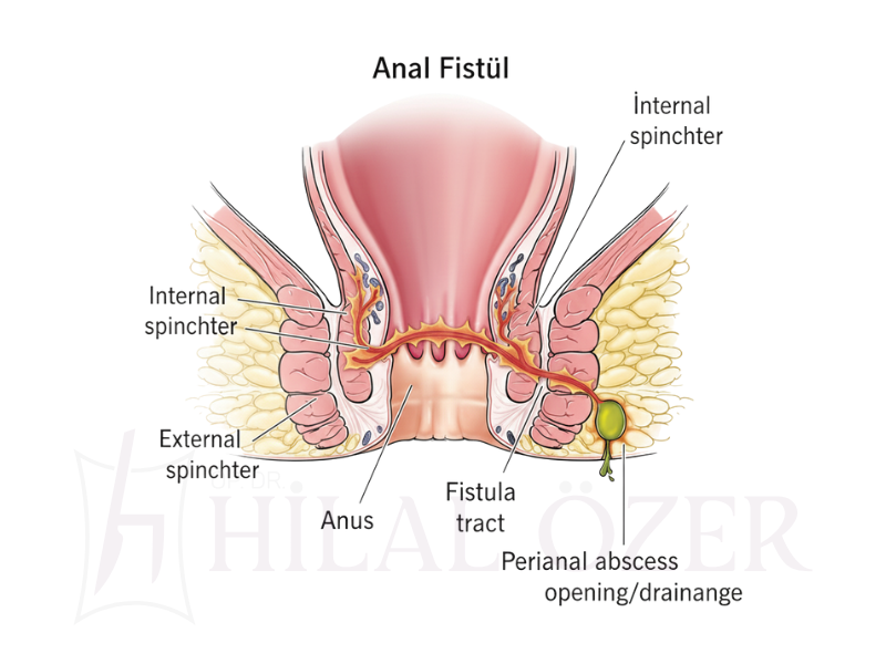 Anal Fistül (Makat Fistülü)