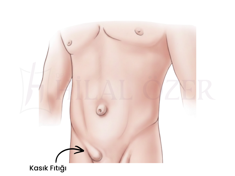 Kasık Fıtığı (İnguinal Herni)