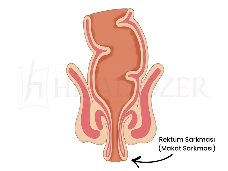 Rektum Sarkması (Makat Sarkması)